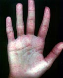 Allergic Hand, allergichand.jpg (4458 bytes)